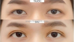 Dịch vụ thẩm mỹ mắt chuyên sâu