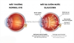 Điều trị phẫu thuật cườm nước (glaucoma): chi phí, phương pháp và quy trình chi tiết