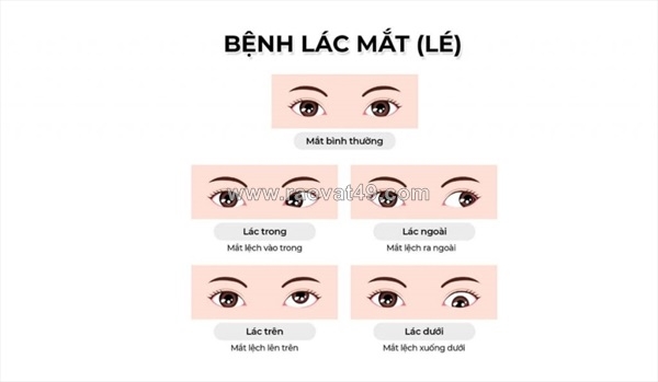 ~/Img/2025/10/hieu-dung-ve-mat-lac-nguyen-nhan-dau-hieu-va-cach-dieu-tri-hieu-qua-02.jpg