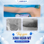 Hút mỡ bắp tay hiện đại – thon gọn, săn chắc tự nhiên