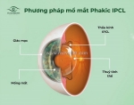 Phakic ipcl: giải pháp tối ưu cho tật khúc xạ nặng và giác mạc mỏng