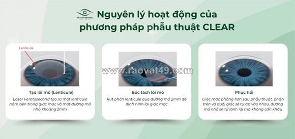 ~/Img/2025/10/phau-thuat-clear-giai-phap-dieu-tri-can-thi-the-he-moi-01.jpg