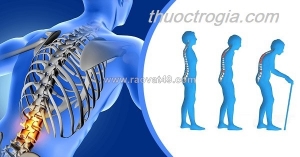 Bệnh loãng xương dưới góc nhìn đông y