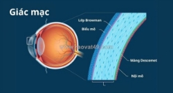 Giác mạc mỏng có mổ cận được không? giải pháp tối ưu nào được khuyến nghị?