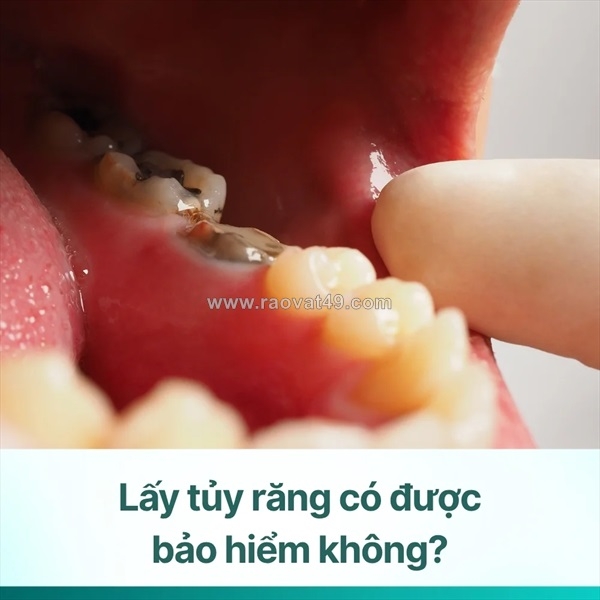 ~/Img/2025/11/lay-tuy-rang-co-duoc-bao-hiem-khong-cach-dung-bhyt-khi-lay-tuy-rang-01.jpg