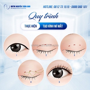 Lợi ích nổi bật của cắt mí mini deep