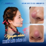 Mũi bị bóng đỏ có ảnh hưởng gì không ?