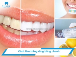 Những rủi ro khi làm trắng răng bằng chanh