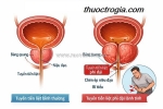 Phì đại tuyến tiền liệt lành tính có nguy hại không?