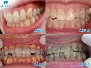 Răng nhiễm tetracycline: nguyên nhân, phân độ và giải pháp khắc phục