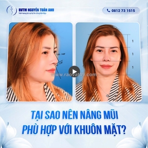 Tạo dáng mũi tự nhiên cùng phương pháp làm đẹp hiện đại