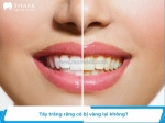 Tẩy trắng răng có bị vàng lại không? cách duy trì răng trắng sáng