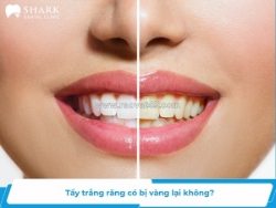 Tẩy trắng răng có bị vàng lại không? cách duy trì răng trắng sáng