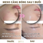 Meso phục hồi da mỏng yếu