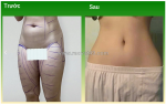 Tạo hình thành bụng – giải pháp lấy lại vòng eo thon gọn