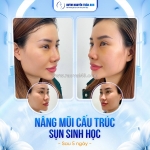 Dáng mũi phổ biến hiện nay và cách nhận biết