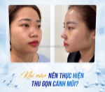 Lợi ích khi thu gọn cánh mũi