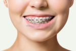 Chi phí làm răng sứ tại tân bình: bảng giá chi tiết & các yếu tố ảnh hưởng