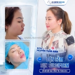 Độn cằm sụn surgiform