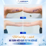 Hút mỡ tay nách – giải pháp cho vùng cánh thon gọn