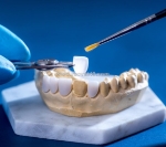 Làm thế nào để tùy chỉnh màu sắc răng sứ zolid để trông tự nhiên nhất?