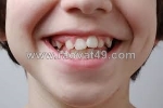 Những rủi ro tiềm ẩn khi giữ răng khểnh là gì?