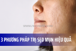3 phương pháp trị sẹo mụn hiệu quả: chiếu tia plasma, lăn kim vi điểm, và silicone gel