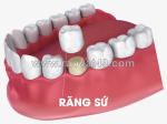Bọc răng sứ titan – giải pháp phục hình răng bền đẹp và tiết kiệm