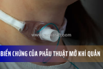Các biến chứng và rủi ro của phẫu thuật mở khí quản