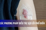 Các phương pháp điều trị sẹo lồi phổ biến
