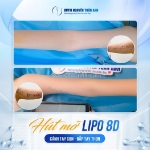 Hút mỡ bắp tay xong có bị to lại không