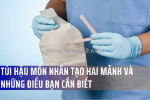 Mọi thứ bạn cần biết về hệ thống túi hậu môn nhân tạo hai mảnh