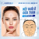 Nốt ruồi giữa trán là tốt hay xấu