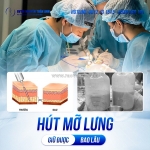 Các công nghệ hút mỡ - sơ lược về hút mỡ