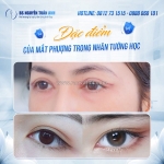 Cắt mí phượng có cải thiện tướng số không