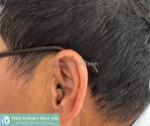 Máy trợ thính nhỏ gọn, kín đáo trong tai