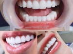 Nên nhổ răng khôn khi nào là tốt nhất?