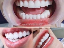 Nên nhổ răng khôn khi nào là tốt nhất?