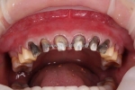 Niềng răng invisalign có giá bao nhiêu tiền? bảng giá cập nhật và các yếu tố ảnh hưởng