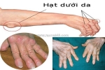 Viêm đa khớp – triệu chứng, biến chứng và cách phòng ngừa hiệu quả