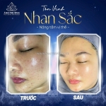 Chỉ 999k – liệu trình xoá nám công nghệ cao trong 30 ngày