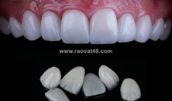 Chi phí niềng răng tại hà nội bao nhiêu?