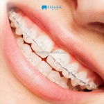 Răng nhỏ có phải là do di truyền không và có cách nào để phòng tránh?