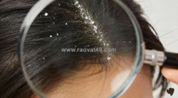 Da đầu bị gàu – nguyên nhân & cách xử lý hiệu quả!