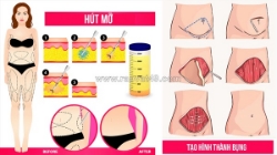 Nên hút mỡ hay tạo hình thành bụng để giữ dáng lâu dài?