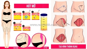 Nên hút mỡ hay tạo hình thành bụng để giữ dáng lâu dài?