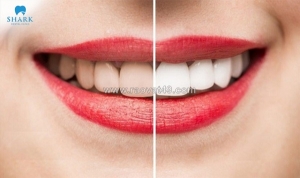 Tẩy trắng răng bao lâu 1 lần để đảm bảo an toàn và hiệu quả?