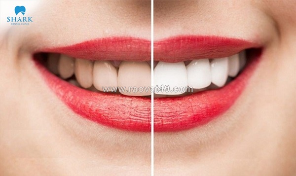 Tẩy trắng răng bao lâu 1 lần để đảm bảo an toàn và hiệu quả?