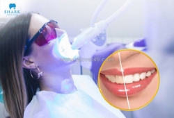 Tẩy trắng răng có nên đánh răng không và cách chăm sóc chuẩn nha khoa