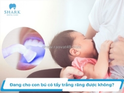 Tẩy trắng răng trong giai đoạn cho con bú: có nên thực hiện và cần lưu ý gì?